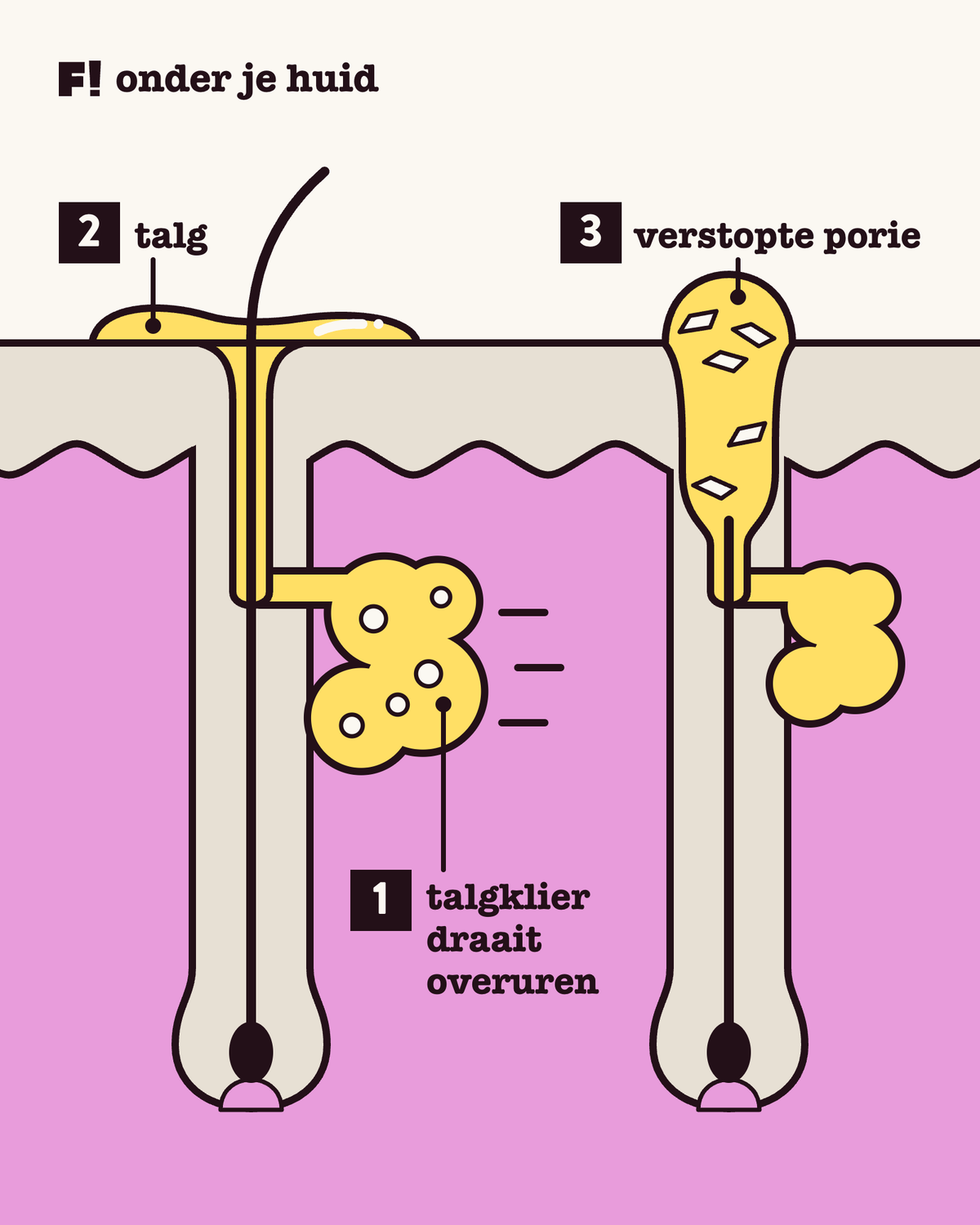 Doorsnede van de huid in drie stappen: een talgklier die overuren draait, talg die als glimmend laagje op de huid blijft liggen, en een porie ernaast die dichtzit met een prop.